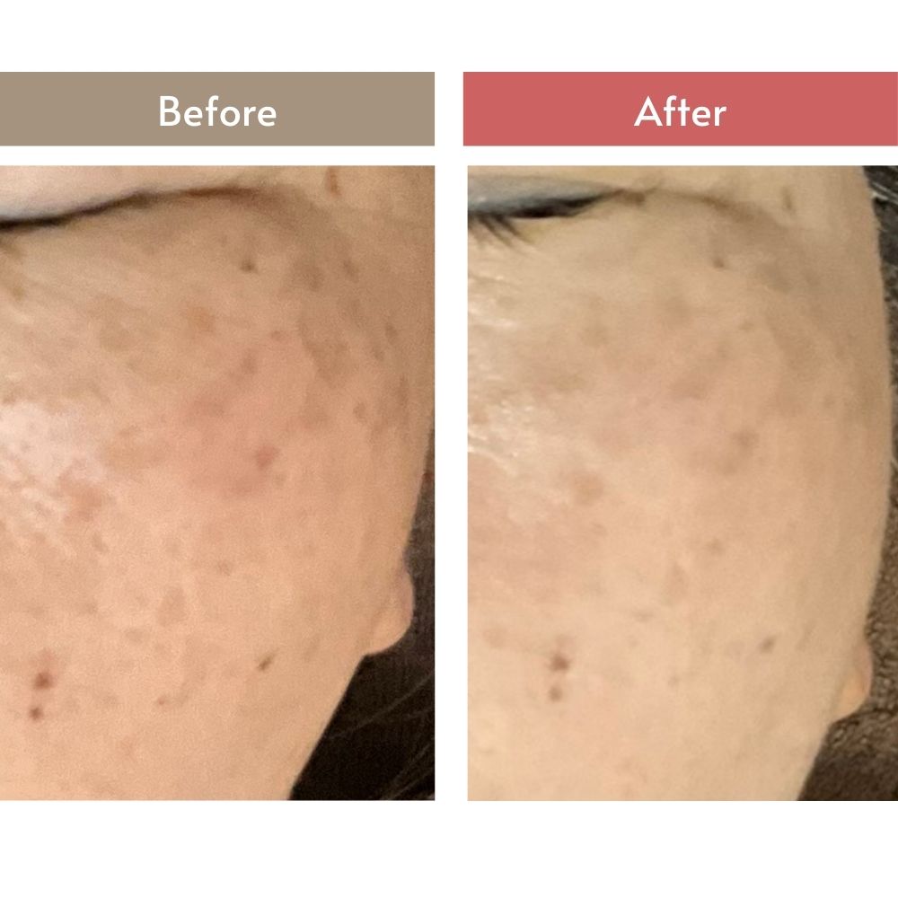 シミが薄く改善