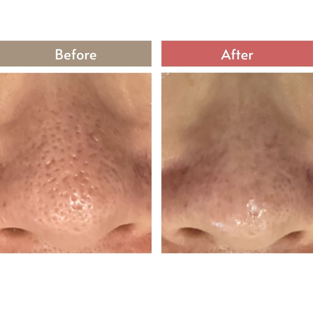 毛穴の黒ずみが取れて引き締まった