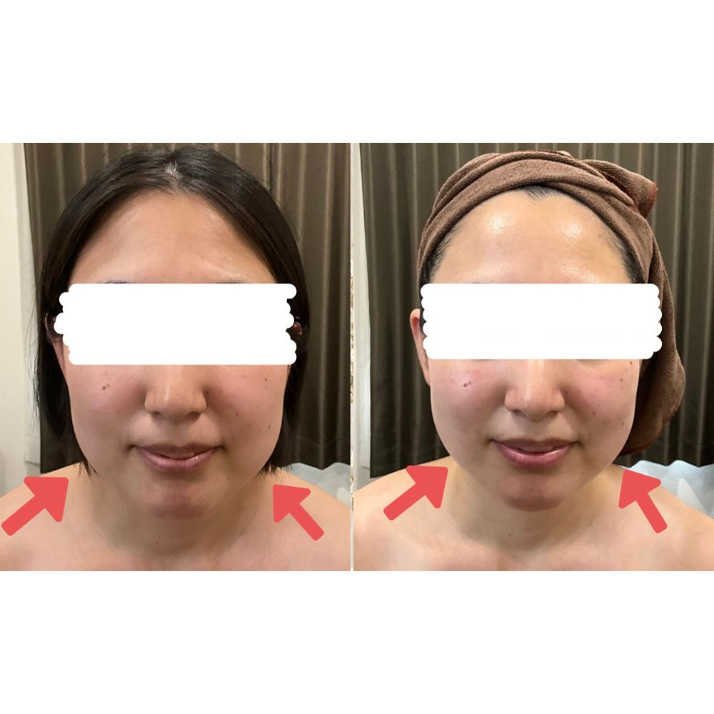 リフトアップして小顔に
